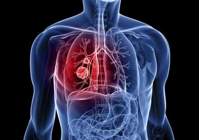 Lung Cancer and the Symptoms